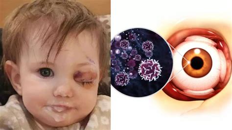 A Year-old Child Loses An Eye To Rare Cancer After Swelling; Symptoms ...