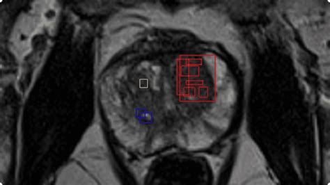 MRI Imaging Analytics for Prostate Cancer - Jiva.ai