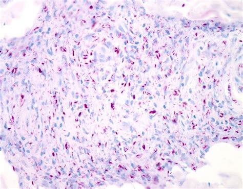 Image:Ziehl-Neelsen Stain (Mycobacterium leprae)-Merck Manual ...