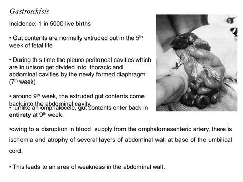 Omphalocele and Gastroschisis | PPTX