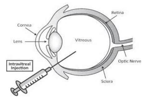 Image result for IVT Injection