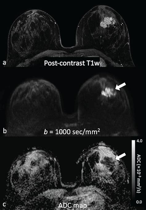 Diffusion MRI as a Stand-Alone Unenhanced Approach for Breast Imaging ...