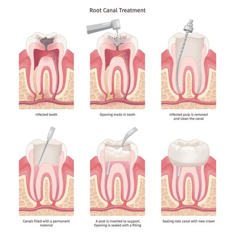 Premium Vector | Root canal treatment Tooth canal rooth filling endodontic procedure roots ...
