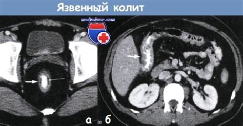 Клиника язвенного колита. Признаки язвенного колита.