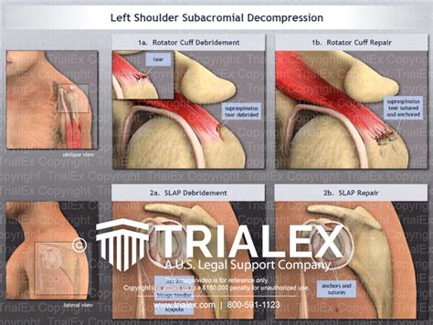 Image result for Subacromial Decompression Rotator Cuff Repair