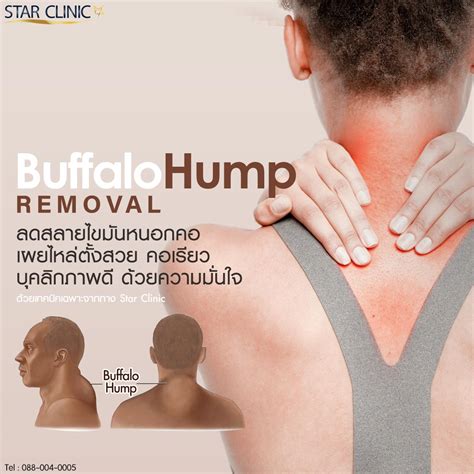 Buffalo Hump Removal หนอกหลังคอ - Star Clinic สตาร์คลินิก