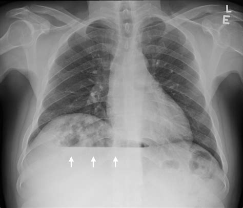 Unusual cause of a radiological subdiaphragmatic air-fluid level ...