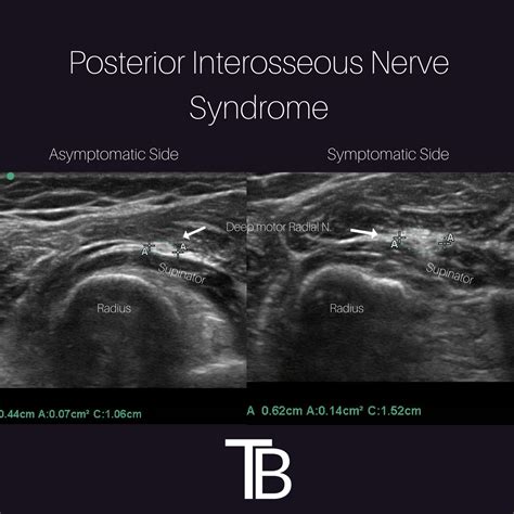 Posterior Interosseous Nerve