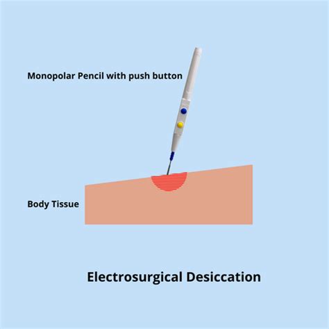 Electrosurgical Pencil / Cautery Pencil and It's Uses