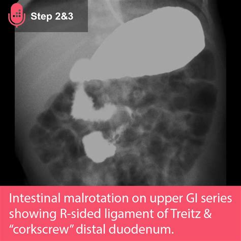 Ligament Of Treitz X Ray Small Bowel Atresias: A Case Series With