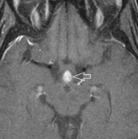 Anatomic and Pathologic Spectrum of Pituitary Infundibulum Lesions | AJR