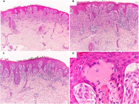 The Morpho-Molecular Landscape of Spitz Neoplasms