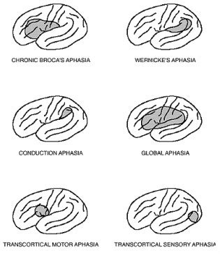 Image result for Conduction Aphasia