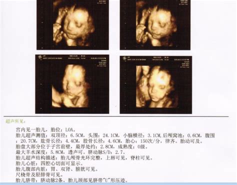 怀孕26周，四维确认男宝一枚，给大家分享症状吧！