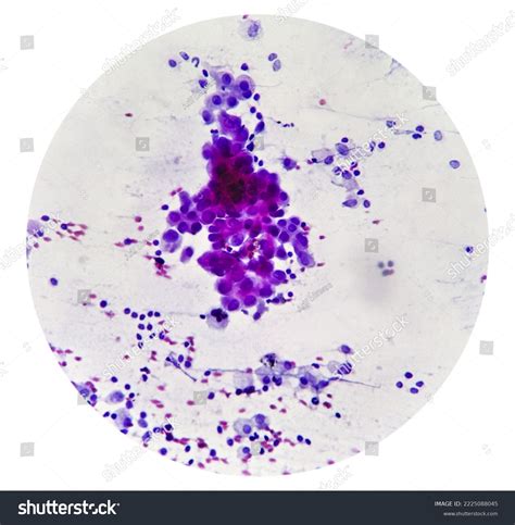 Intra Abdominal Masscytology Spindle Cell Sarcoma Stock Photo ...