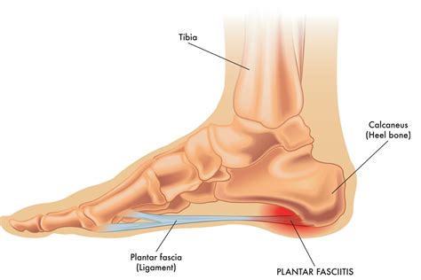 Plantar Fasciitis Symptoms, Causes & Treatments | Advanced Surgery Center
