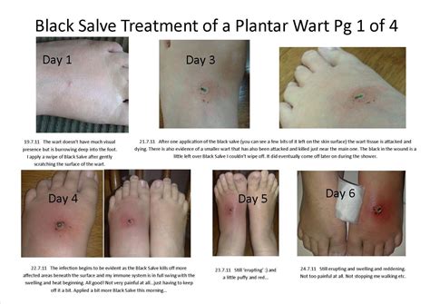 Plantar Wart Diagram