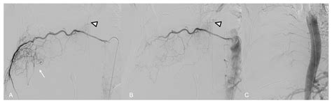 Preoperative Embolization in the Management of Giant Thoracic Tumors: A ...