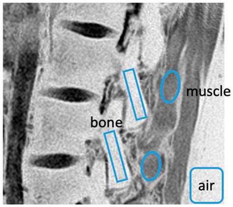 Ultrashort Echo Time and Fast Field Echo Imaging for Spine Bone Imaging ...