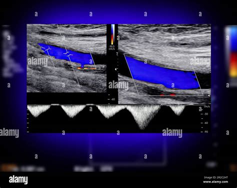 A carotid artery Doppler ultrasound is a diagnostic test used to check ...