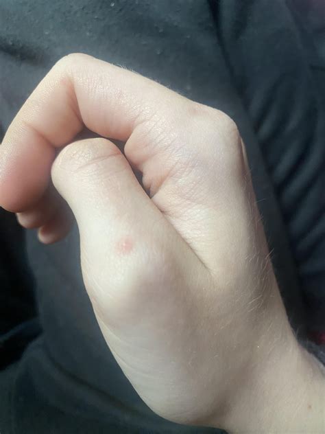 What are these red bumps around my knuckles? they came out of nowhere : r/Dermatology