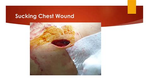 Penetrating Chest Injury.pdf