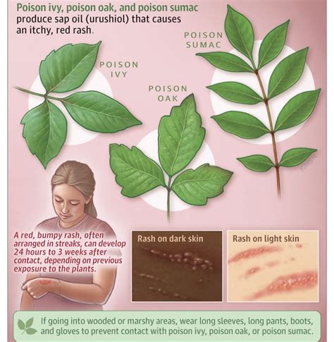 Andy Hoepelman on LinkedIn: Allergic reactions to Poison Ivy, Poison ...
