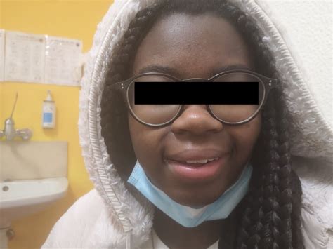 Acute oromandibular dystonia | Pediatric Oncall Journal