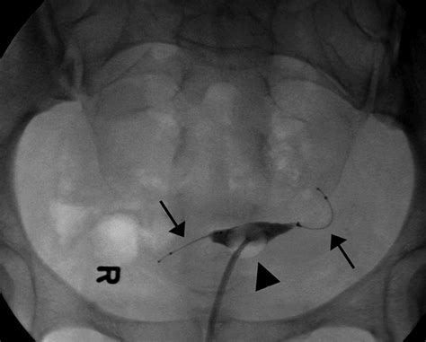 Essure Logo Sonography, CT, And MRI Appearance Of The Essure