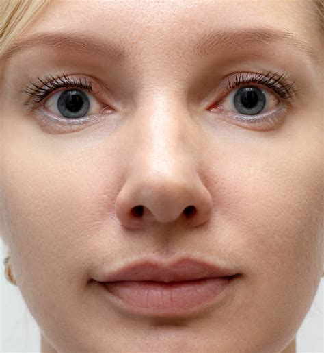 Micro-Needling – Entourage MD Skin and Wellness