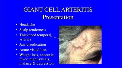 Giant Cell Arteritis causes symptoms and treatments