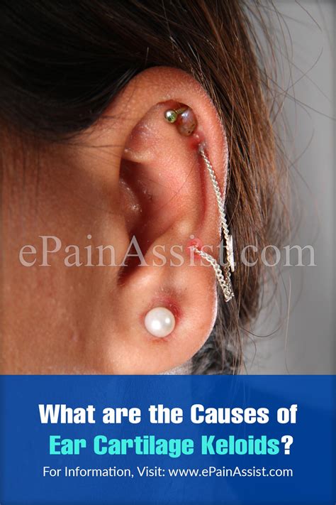 Ear Cartilage