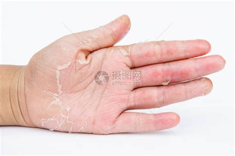 干手皮革接触皮炎真菌感染高清图片下载-正版图片503155380-摄图网