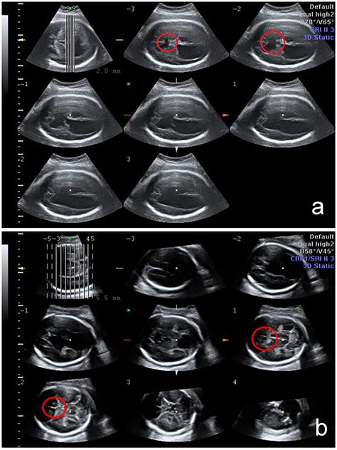 Cavum Septum Pellucidum Fetal Ultrasound