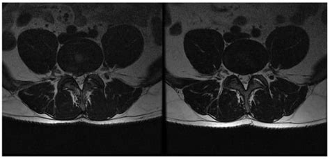 Efficacy of DiscoGel in Treatment of Degenerative Disc Disease: A ...