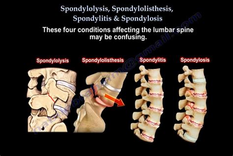What Is Spondylolysis And Spondylolisthesis - mapasgmaes