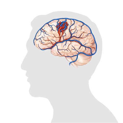 Image result for AVM Brain