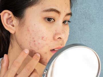 Everything To Know About Cystic Acne, And How To Treat It | Femina.in
