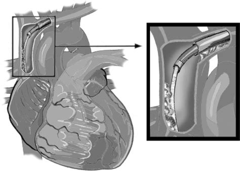 Image result for Laser Lead Extraction Animation Spectranetics