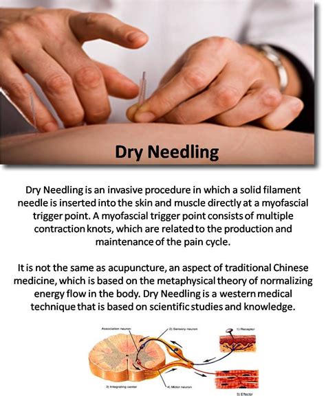 Home : Physiotherapy Associates | Dry needling therapy, Dry needling ...
