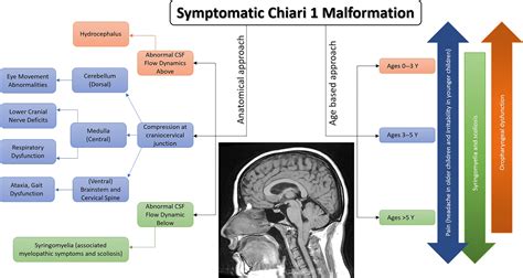 Clinical Manifestations of Chiari I Malformation - Neurosurgery Clinics