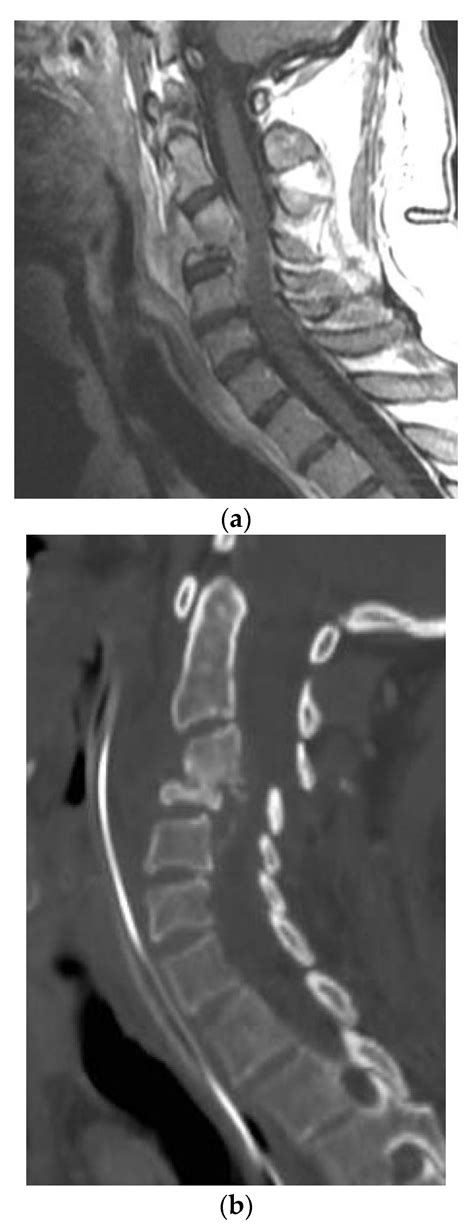 Disseminated Coccidioidomycosis to the Spine—Case Series and Review of ...