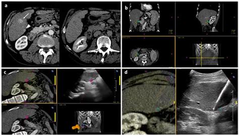 Percutaneous Microwave Ablation of Hepatocellular Carcinoma with ...