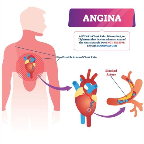 Angina: Causes, Risk Factors, Symptoms, Treatment