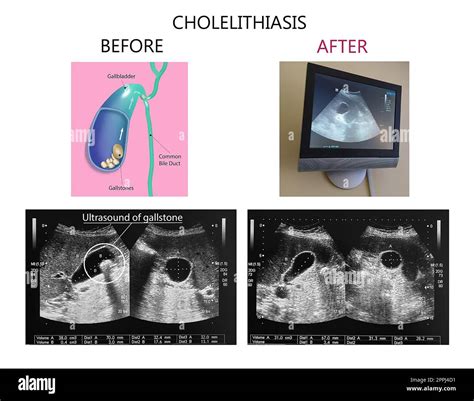 Gallstone Ultrasound Ultrasonography Of Gallstones Radlines.org