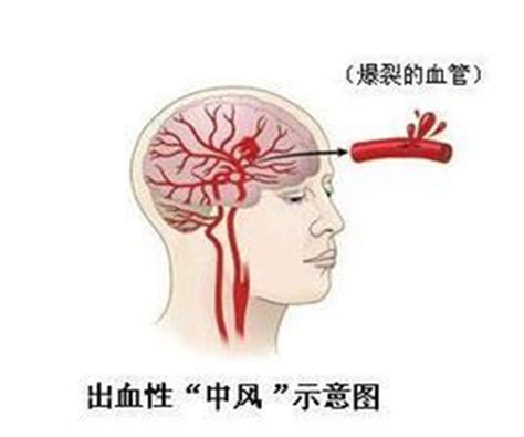 脑出血的概述_上海蓝十字脑科医院官网_同济大学附属脑科医院（筹）