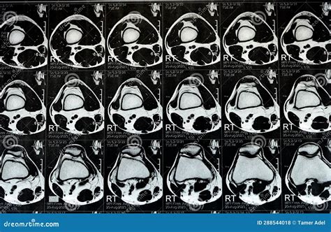 MRI of the Right Knee Showing Mild Joint Effusion, with Normal Other ...