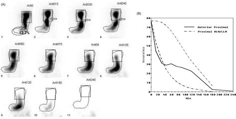 Gastric emptying scintigraphy - Clinical Tree