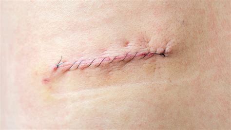 Wound Dehiscence - Medical Monks