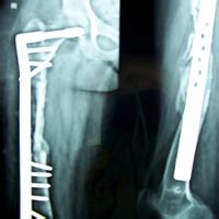 Limb Reconstruction Doctor in Ahmedabad Gujarat Rajasthan | Dr. Mehul H ...